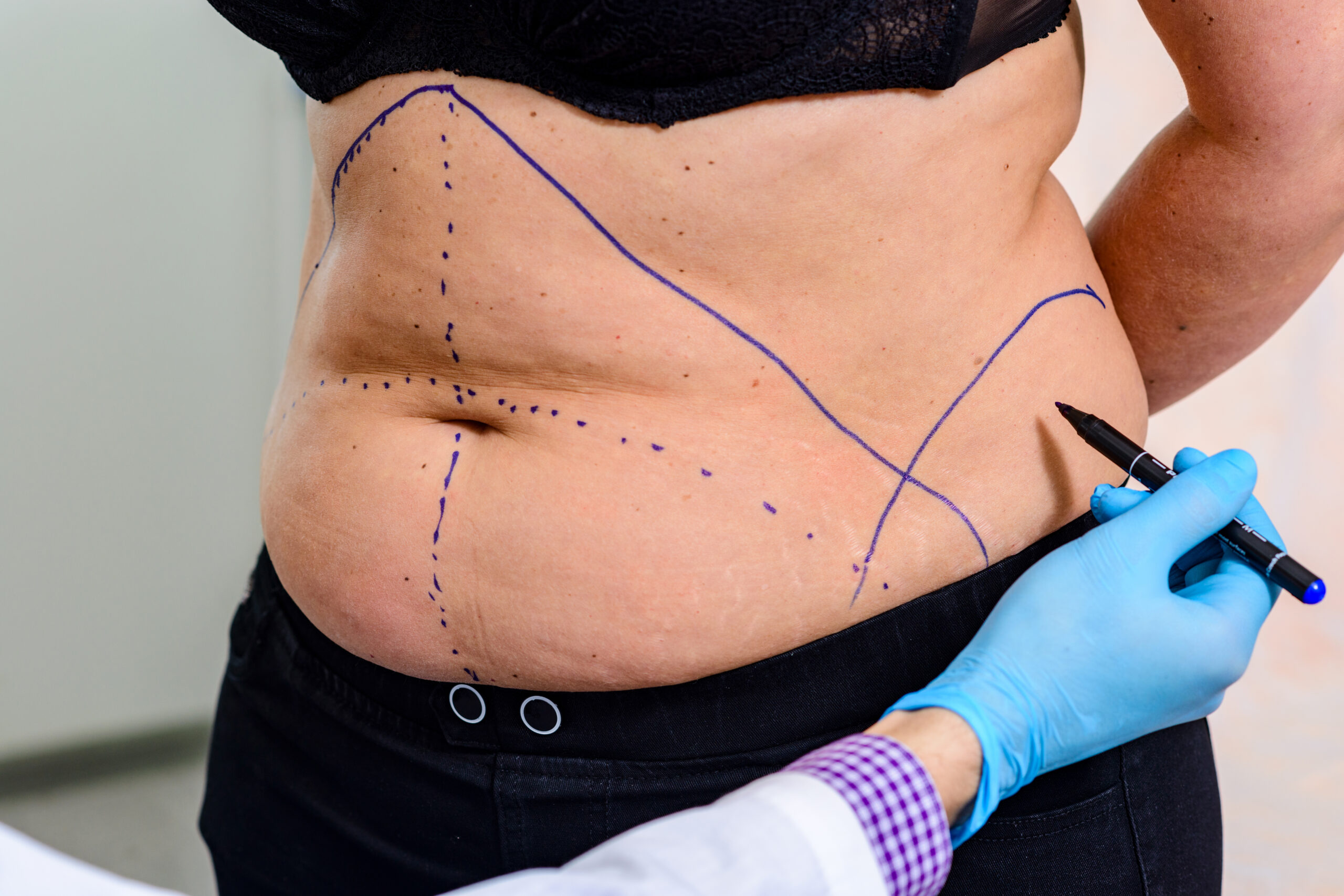 The doctor drawing lines on the patient’s skin